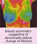 Breast asymmetry suggestive of abnormality before change of lifestyle